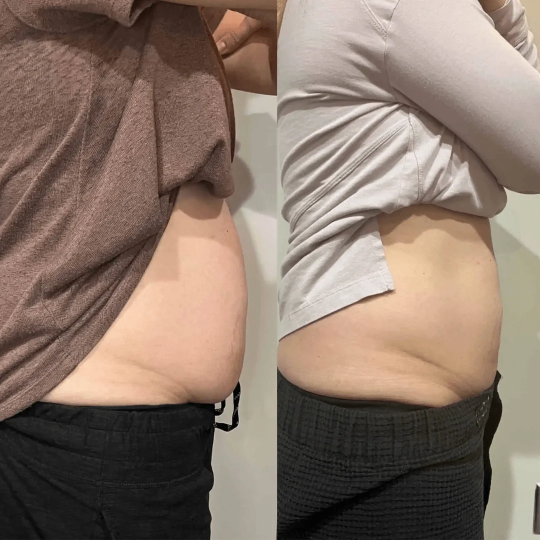 Before-and-After-Cool-Sculpting