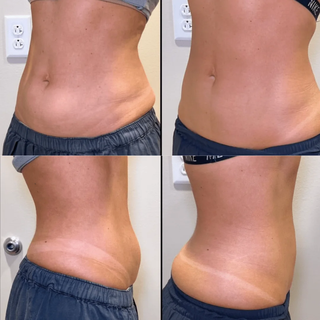 Before-and-After-Cool-Sculpting