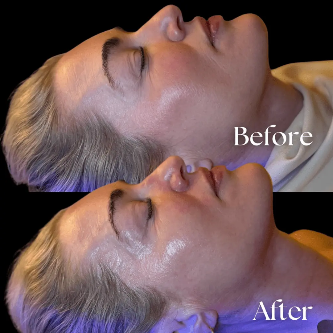 Facial-before-and-after