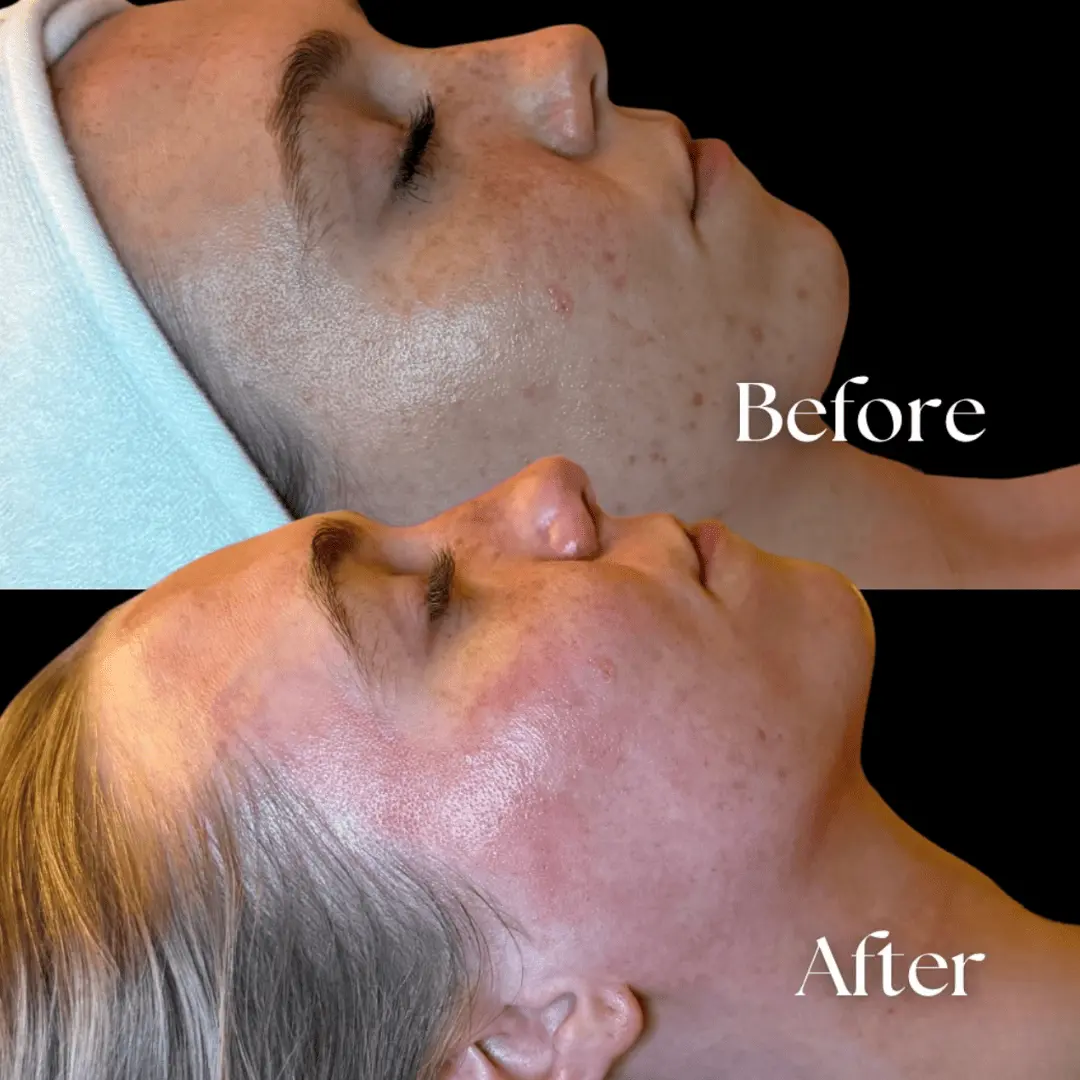 Facial-before-and-after