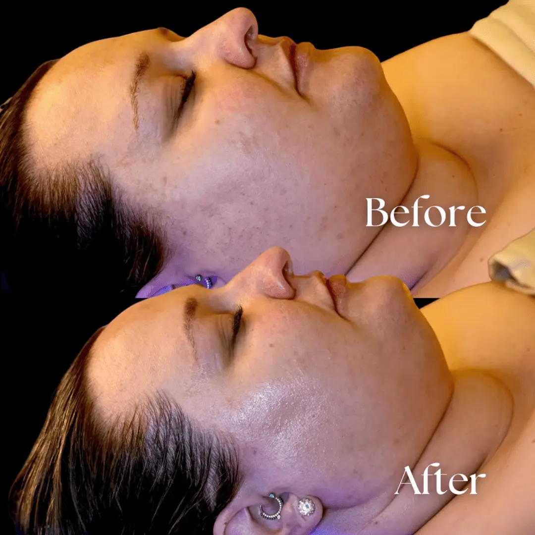 Facial-before-and-after