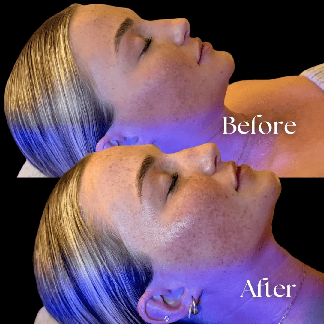 Facial-before-and-after