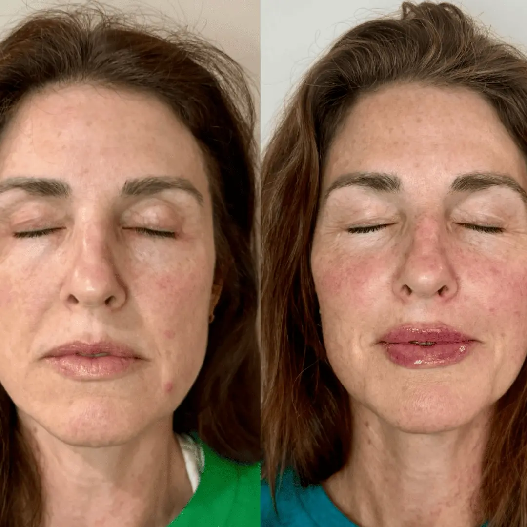 Filler-Before-and-after