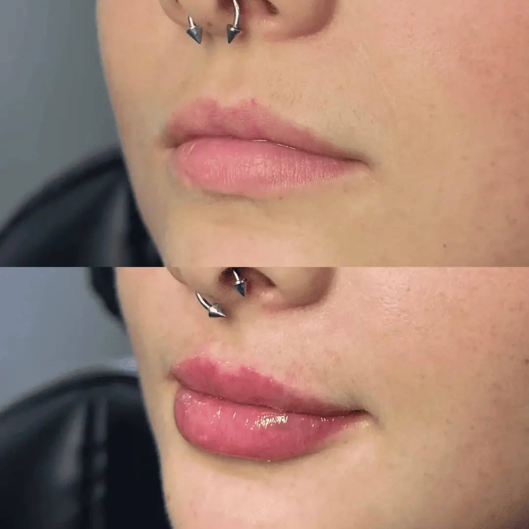 Filler-Before-and-after