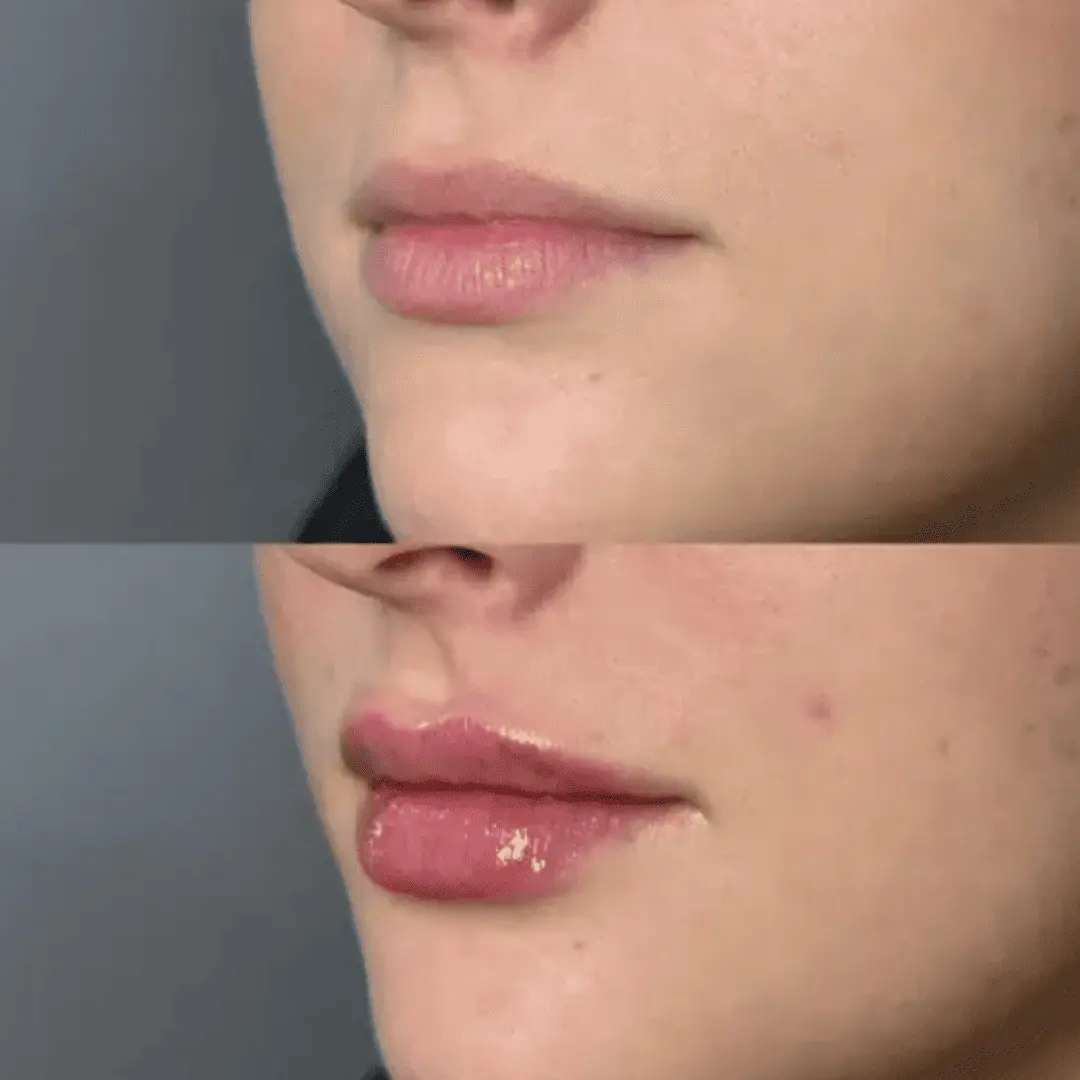 Filler-Before-and-after