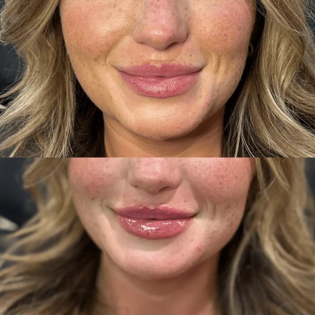 Filler-Before-and-after