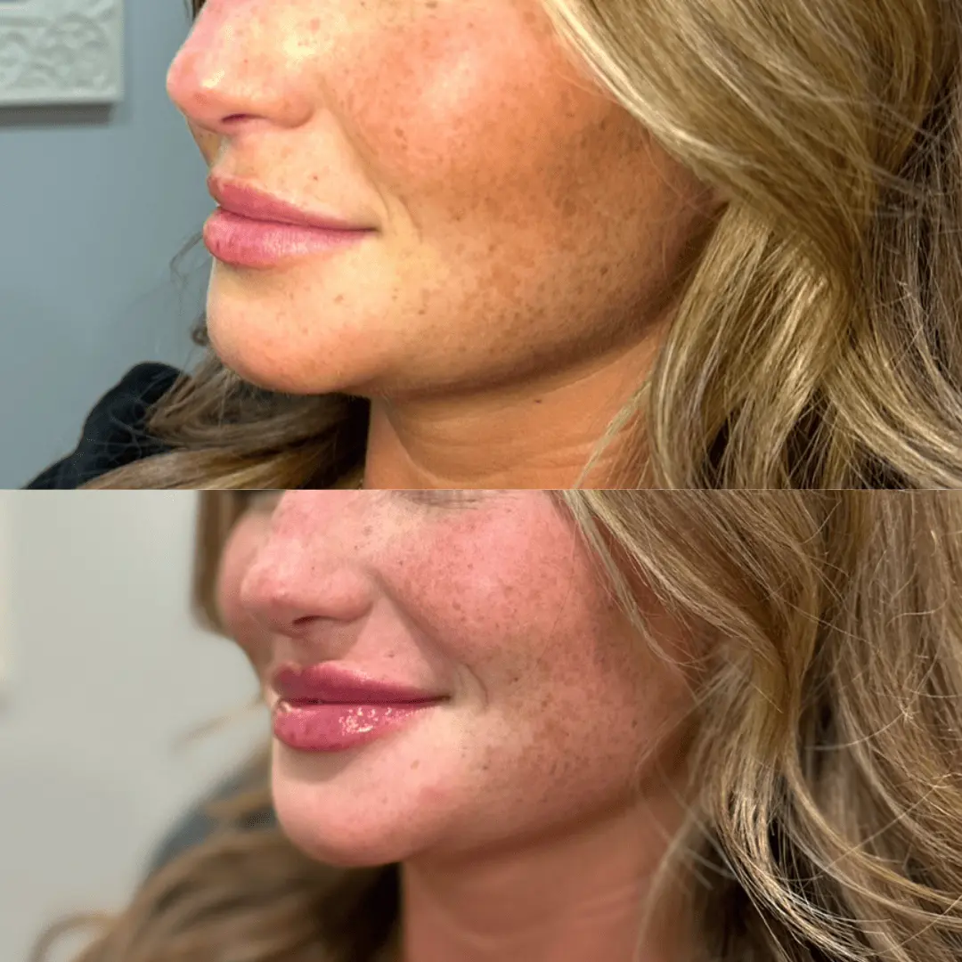 Filler-Before-and-after