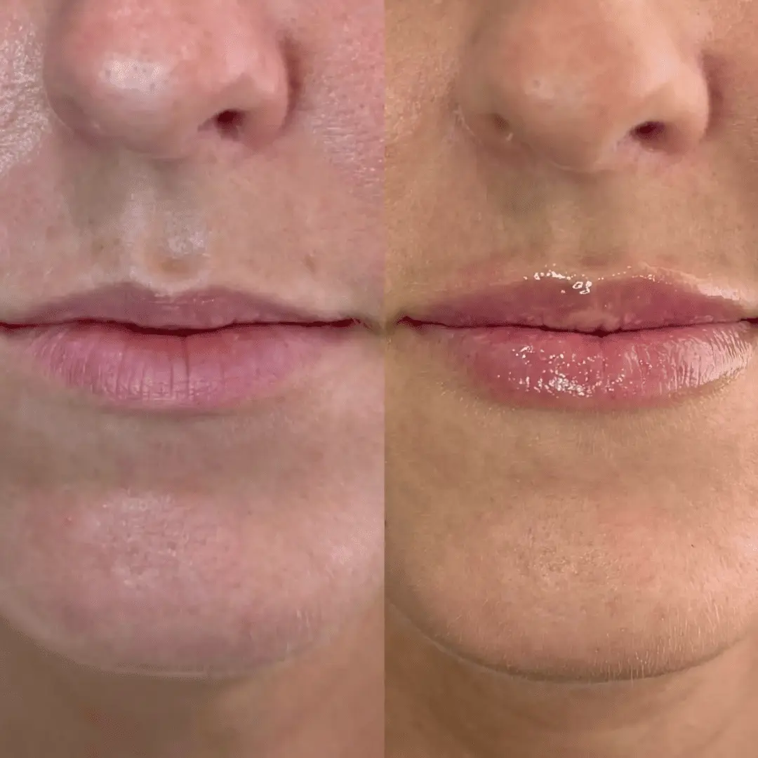 Filler-Before-and-after
