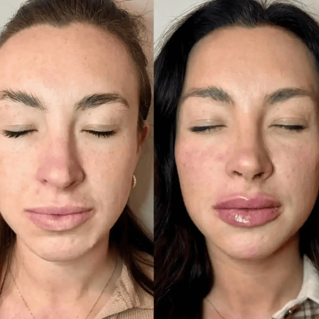 Filler-Before-and-after