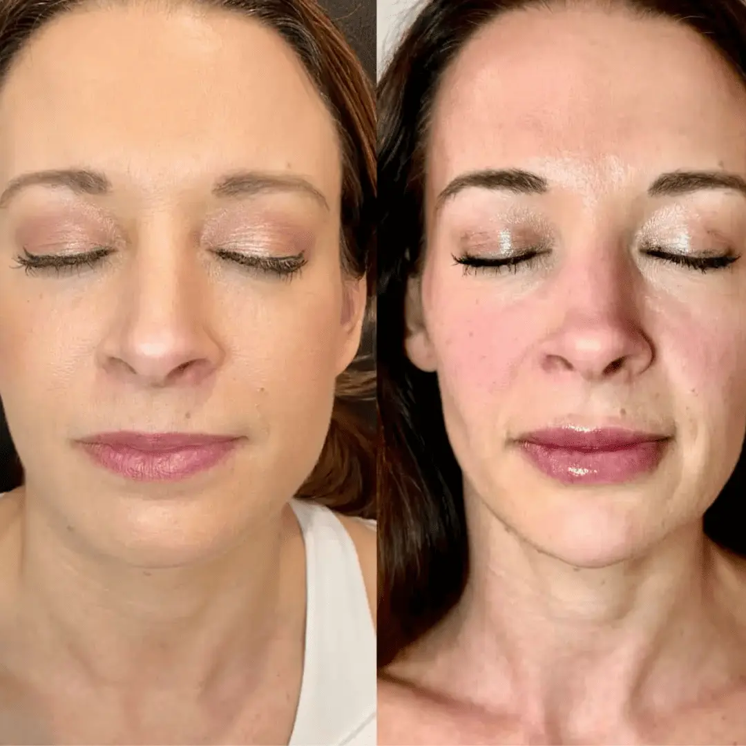 Filler-Before-and-after