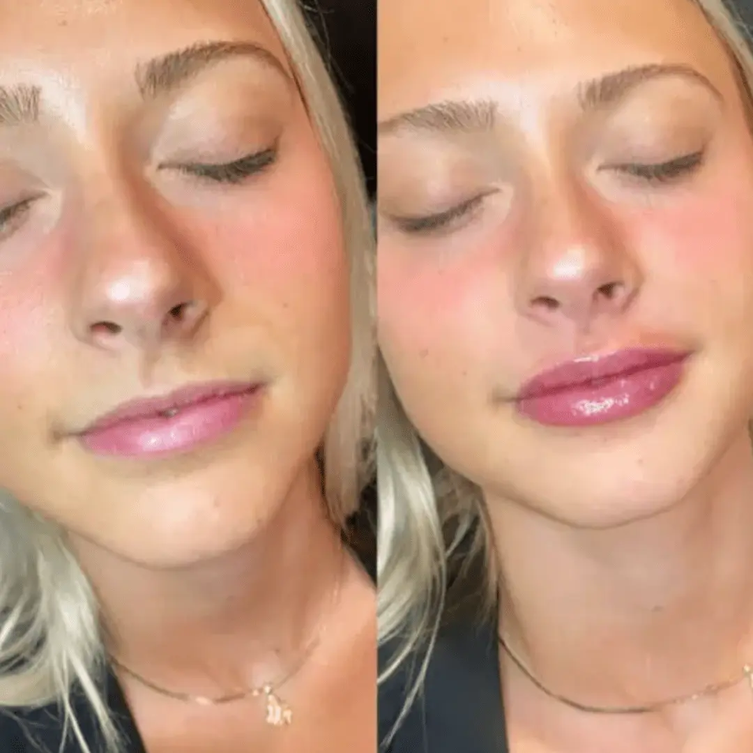 Filler-Before-and-after