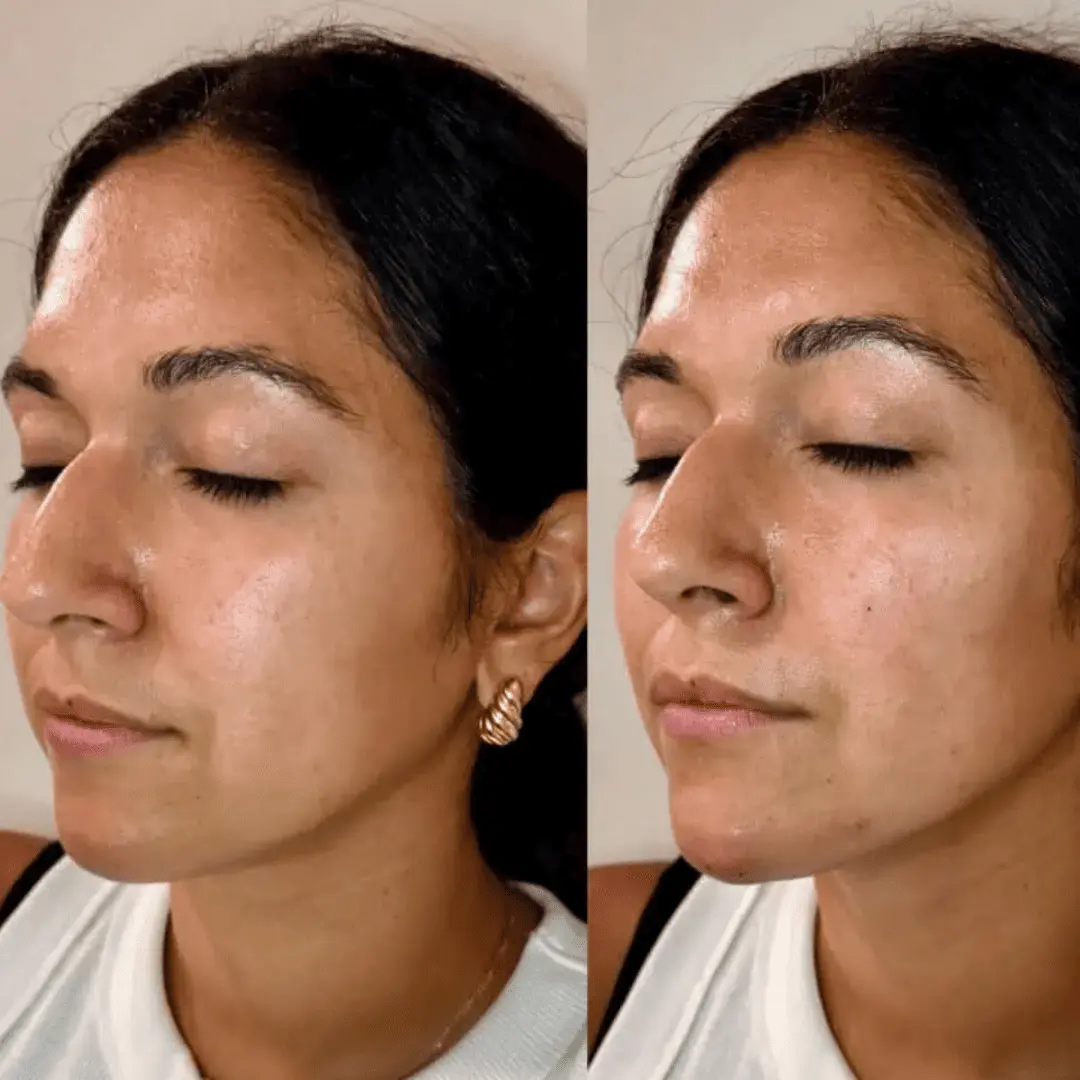 Filler-Before-and-after
