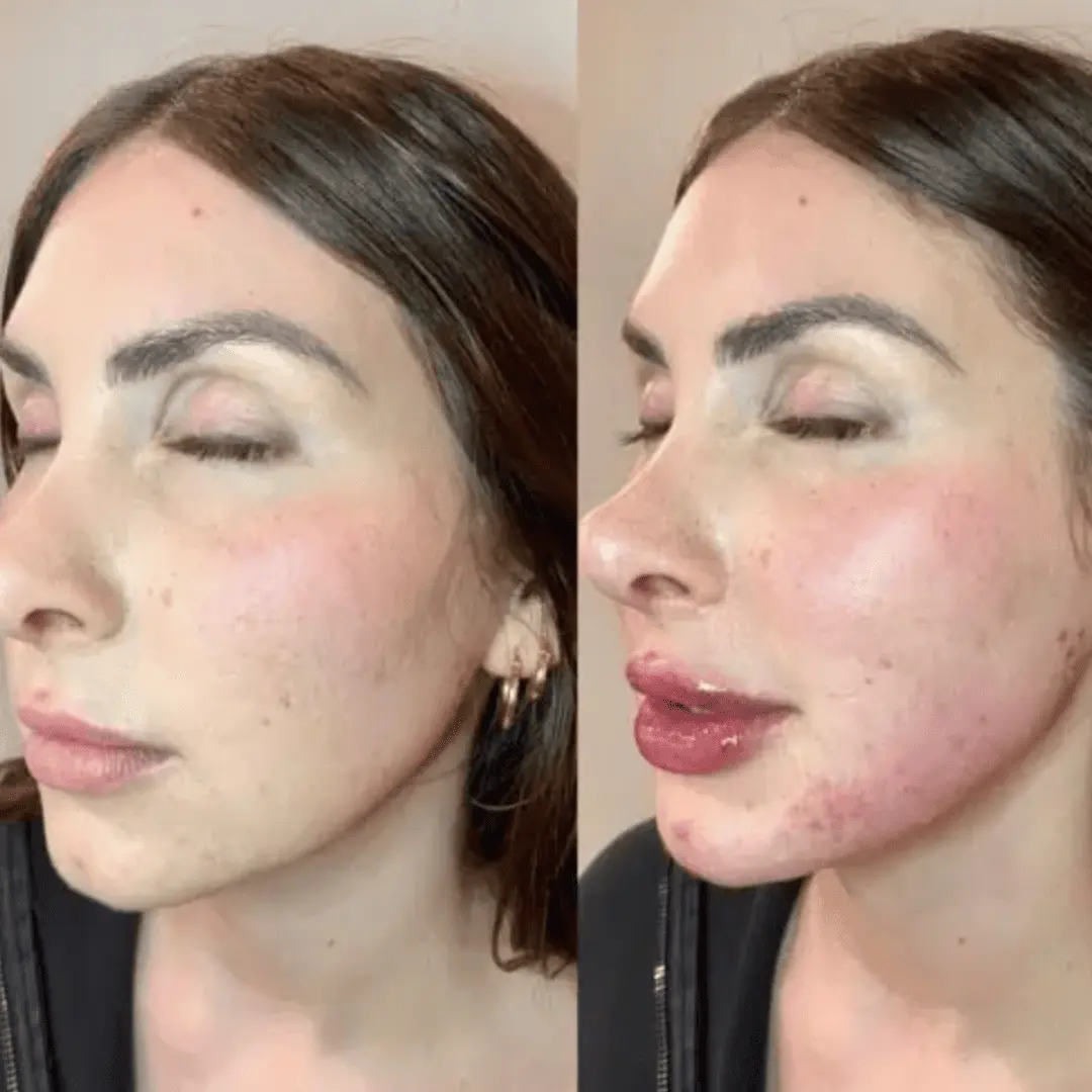 Filler-Before-and-after