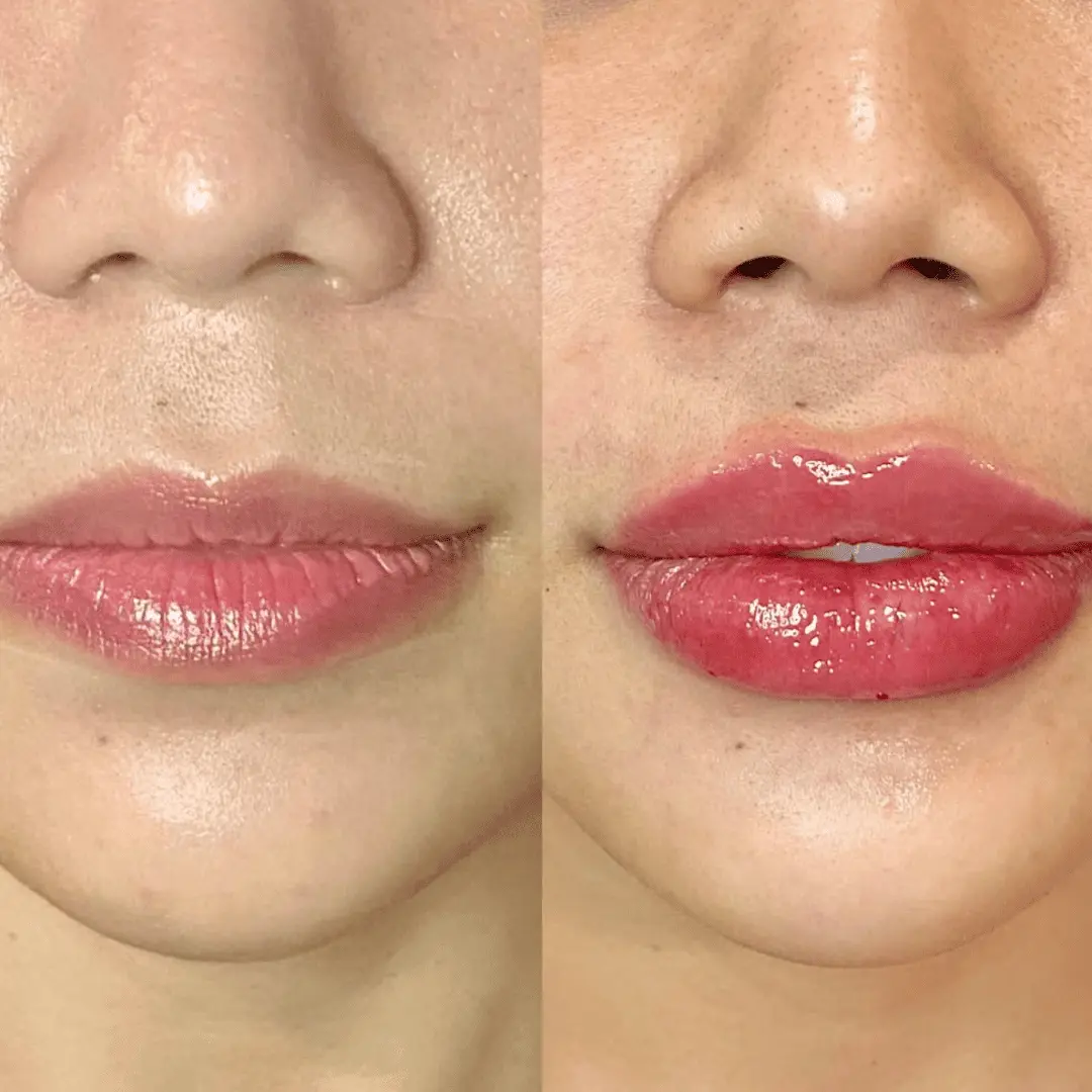 Filler-Before-and-after