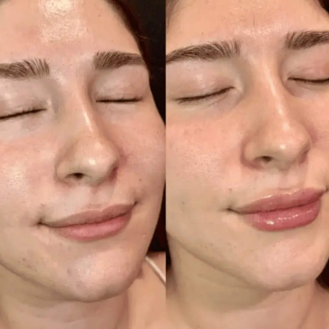 Filler-Before-and-after