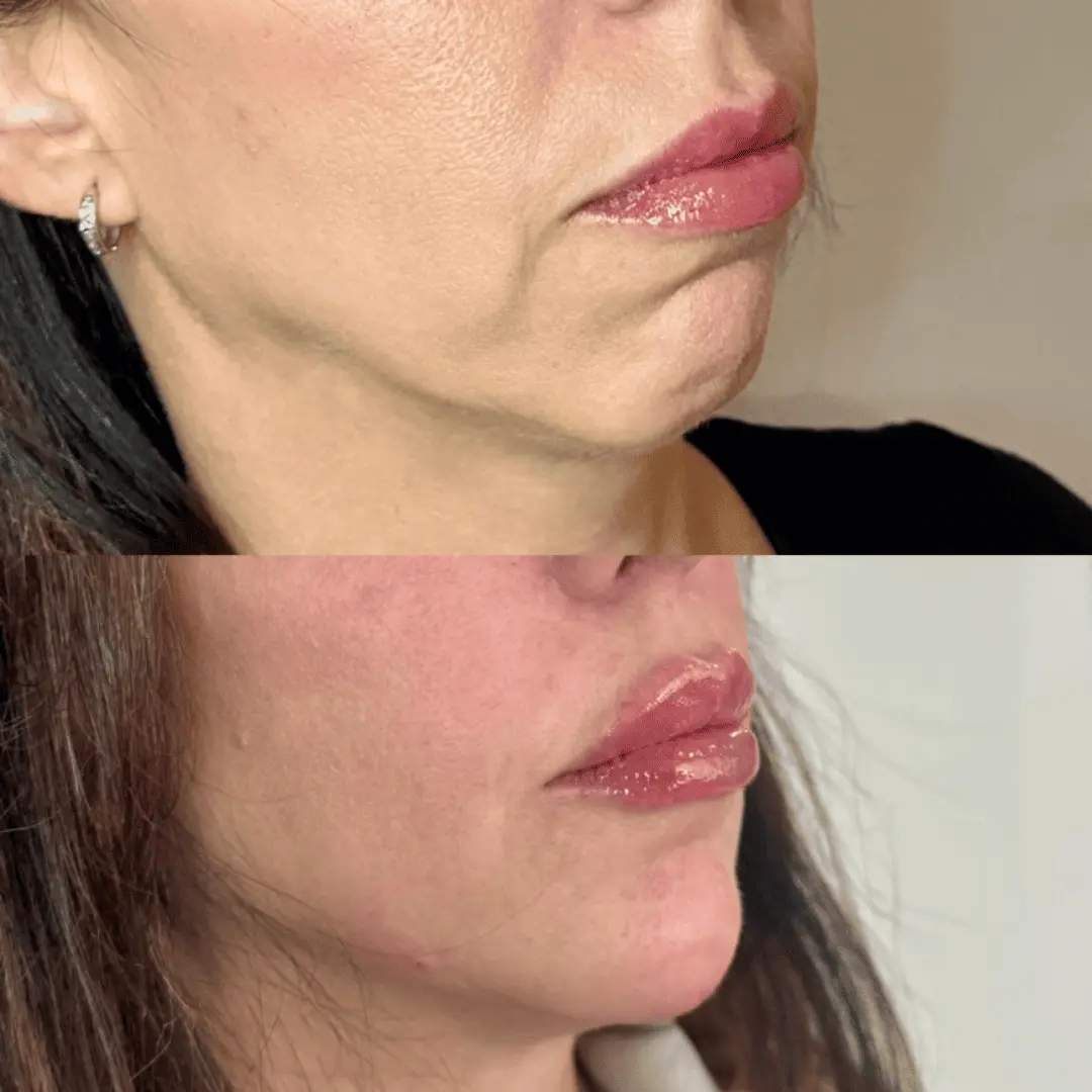 Filler-Before-and-after
