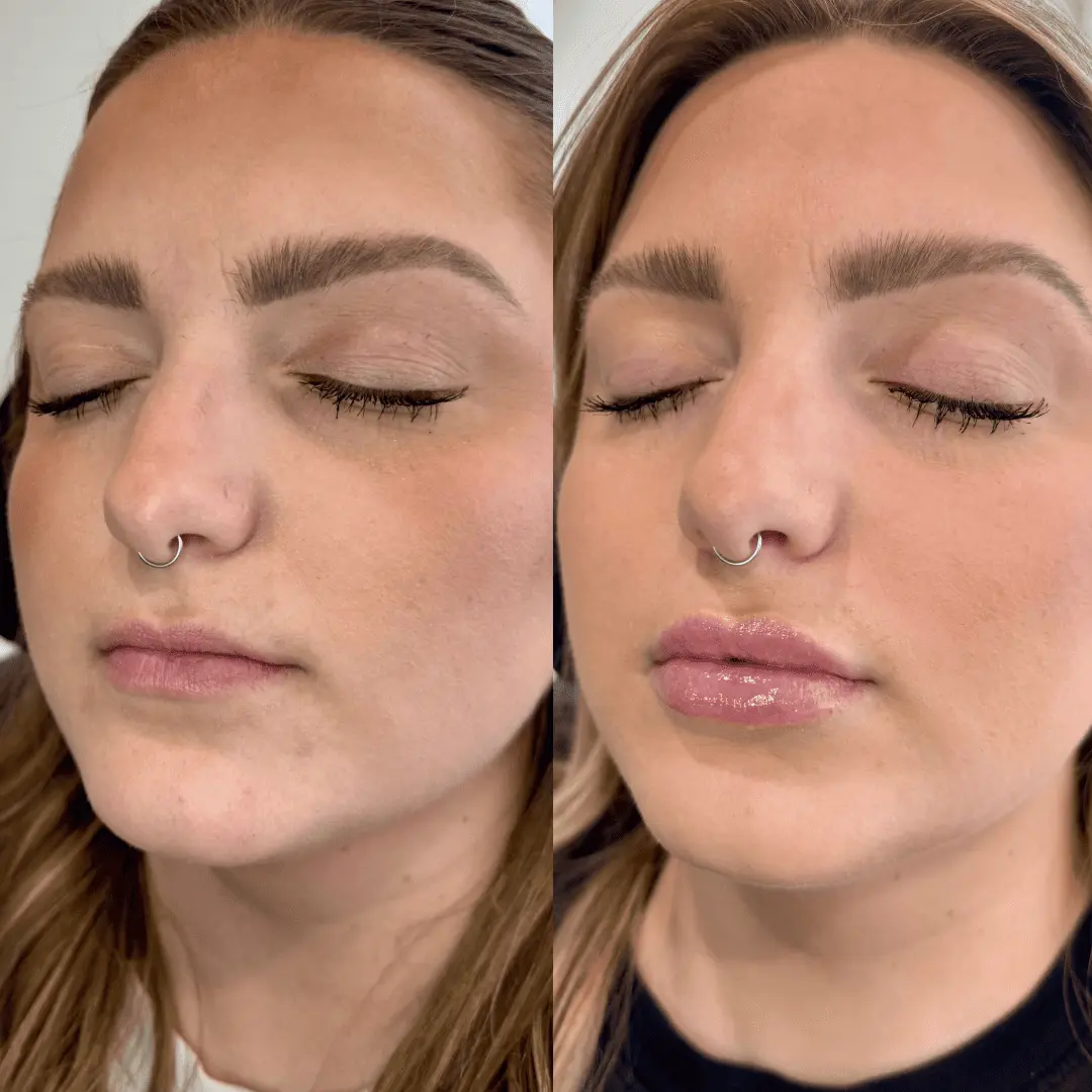 Filler-Before-and-after