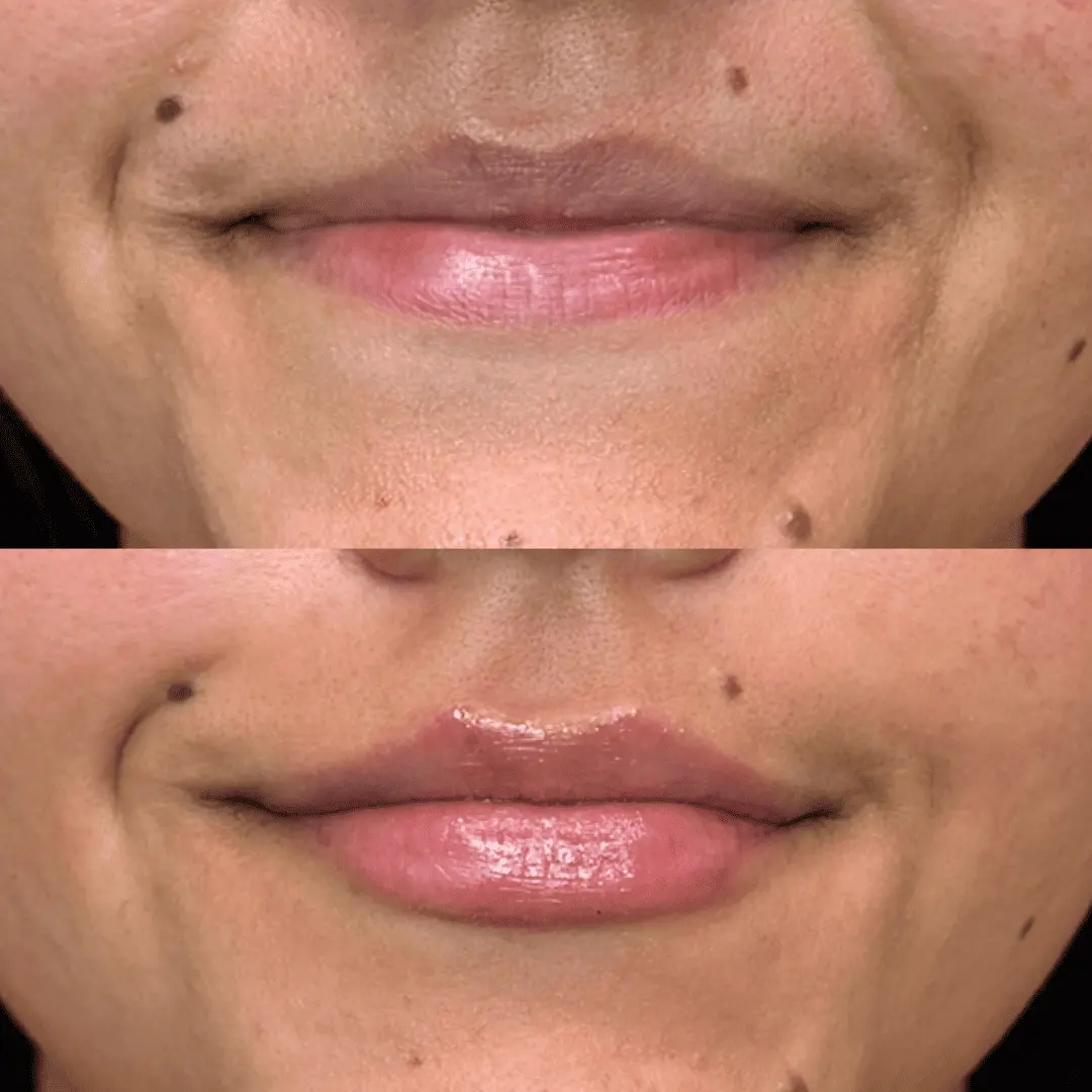 Filler-Before-and-after