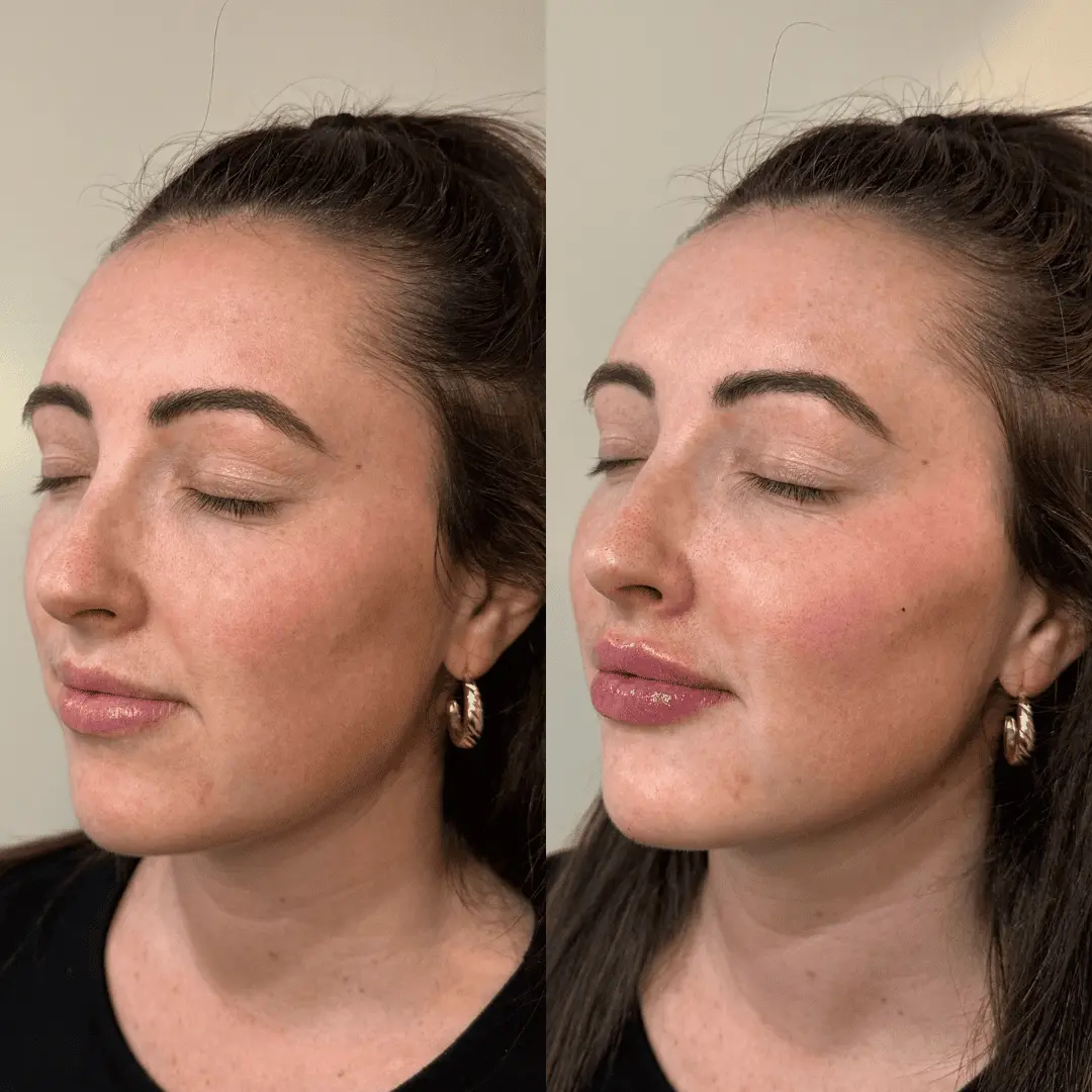 Filler-Before-and-after