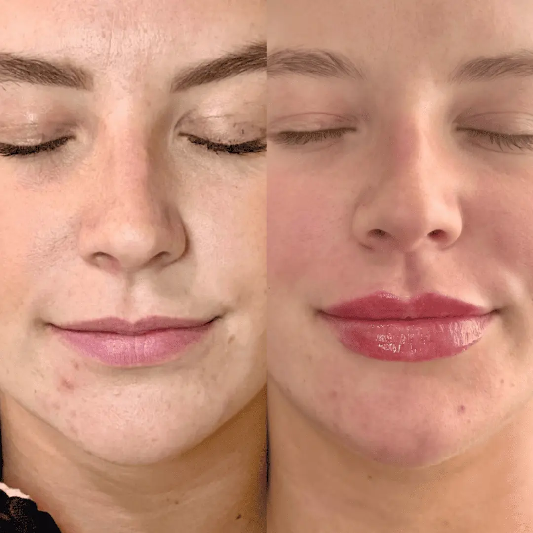 Filler-Before-and-after