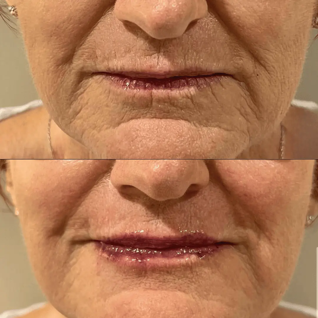 Filler-Before-and-after