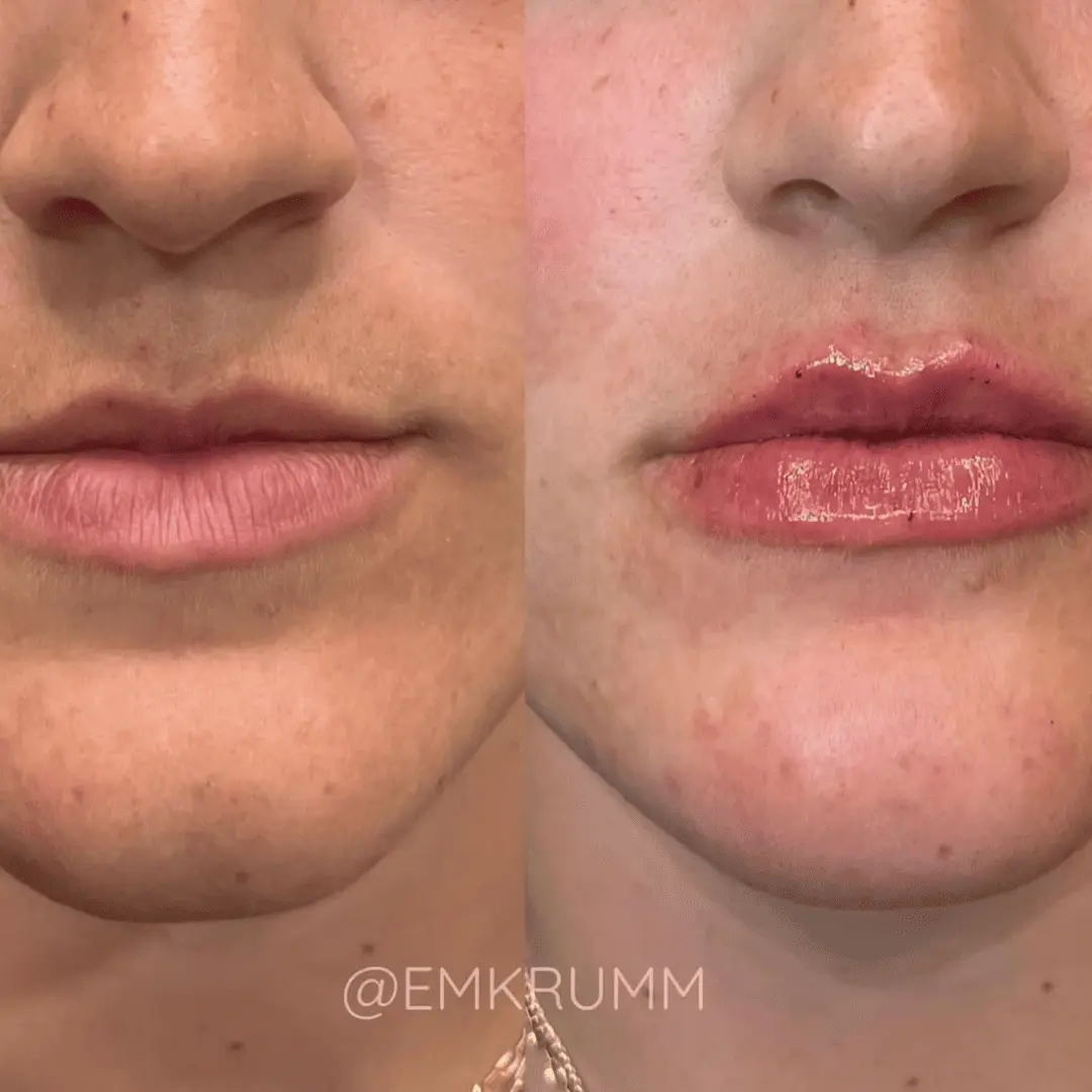Filler-Before-and-after