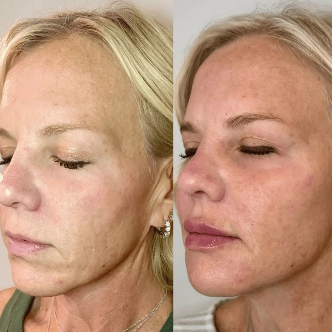 Filler-Before-and-after