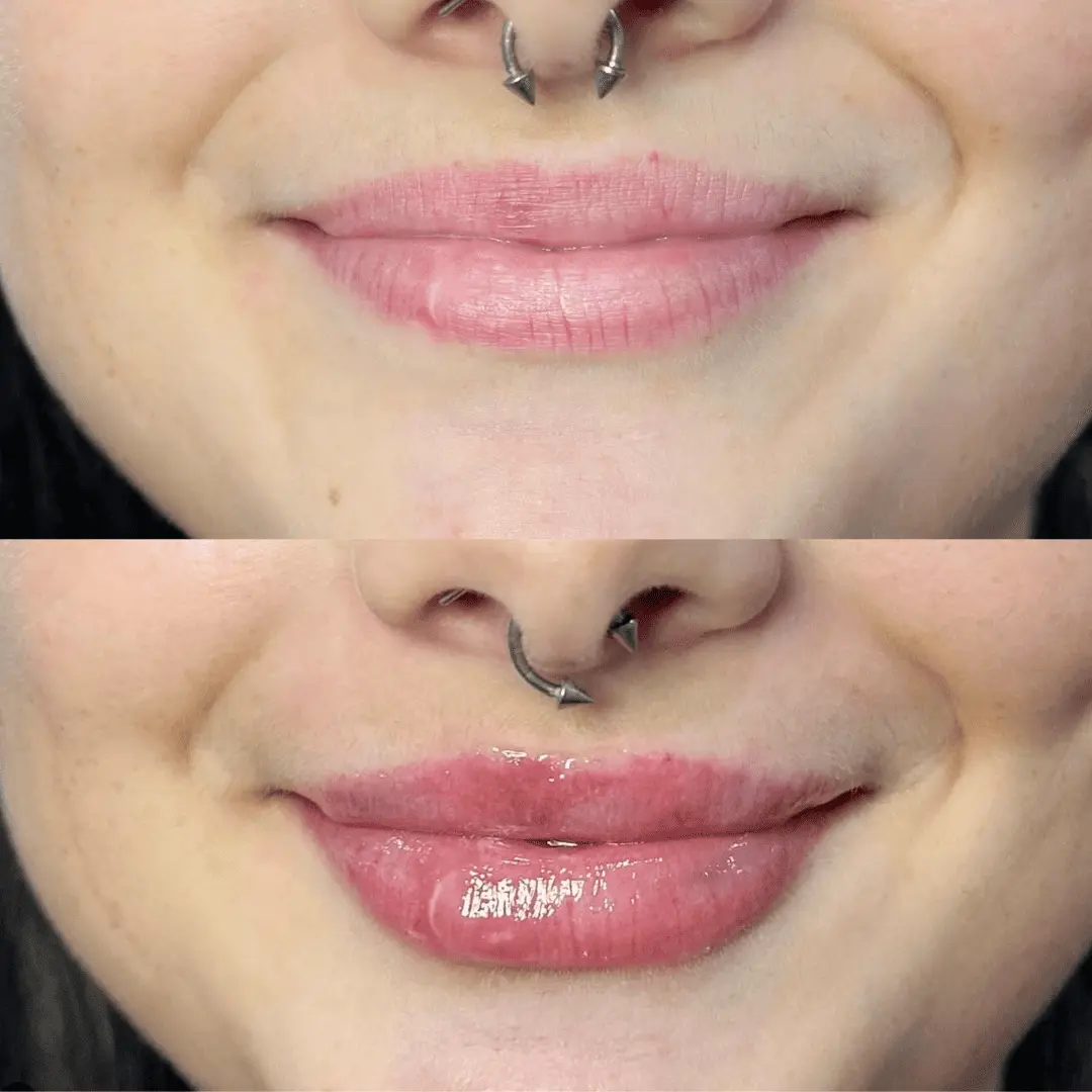 Filler-Before-and-after