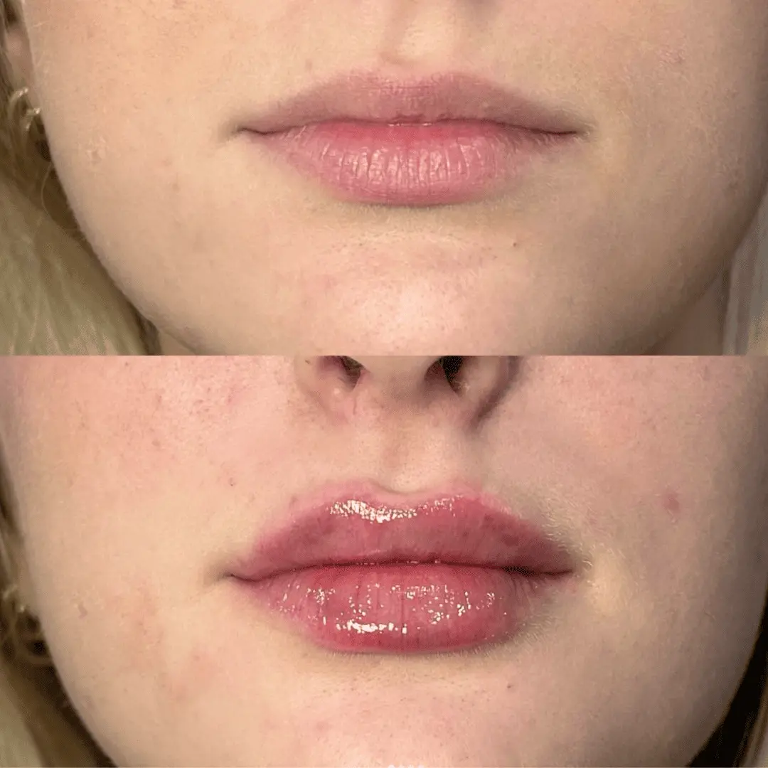 Filler-Before-and-after