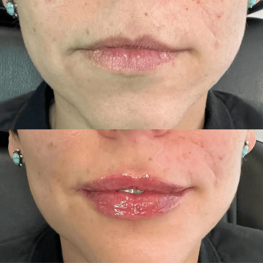 Filler-Before-and-after