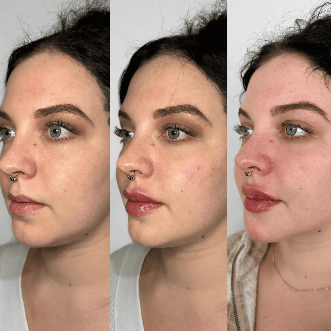 Filler-Before-and-after