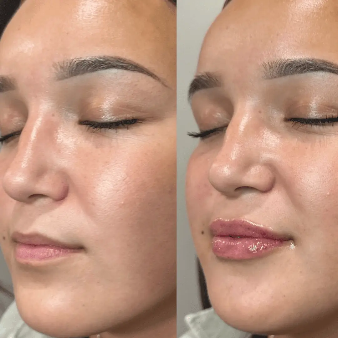 Filler-Before-and-after