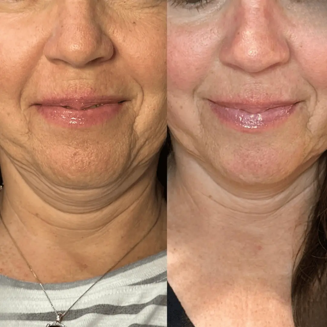 morpheus8-before-and-after