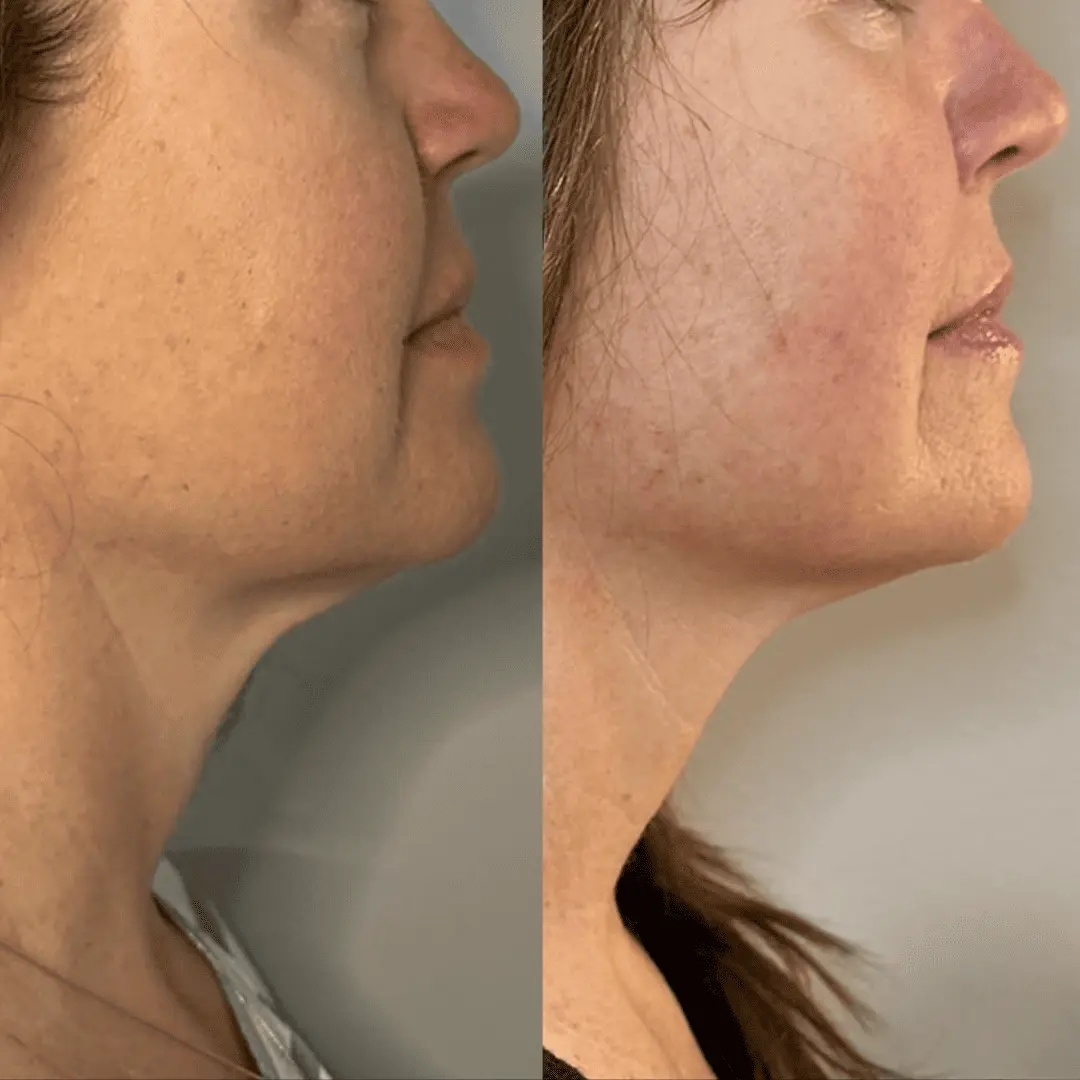 morpheus8-before-and-after