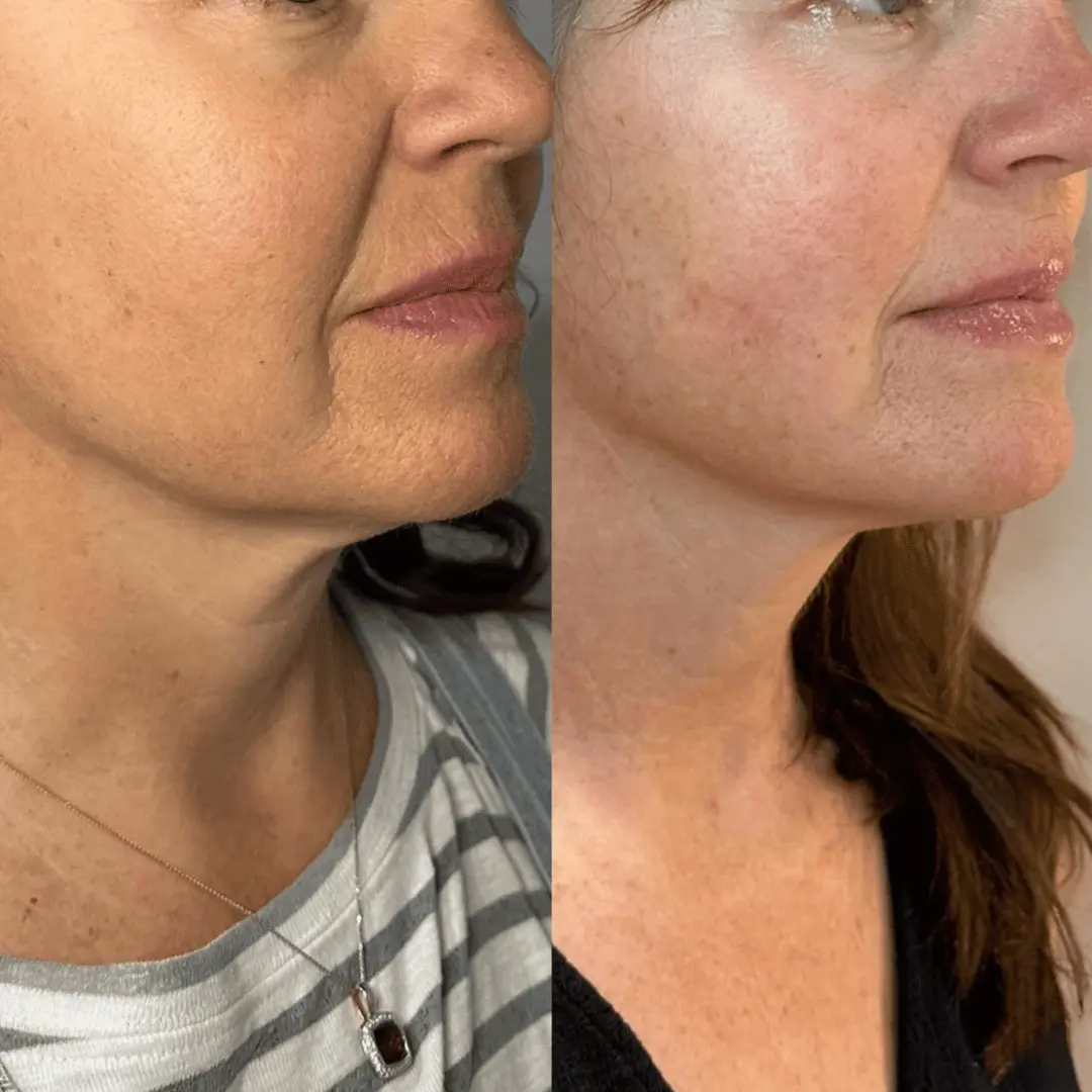morpheus8-before-and-after