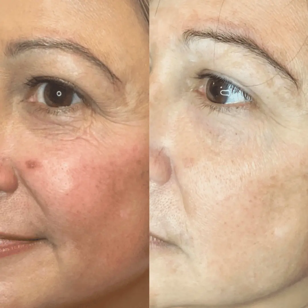 morpheus8-before-and-after