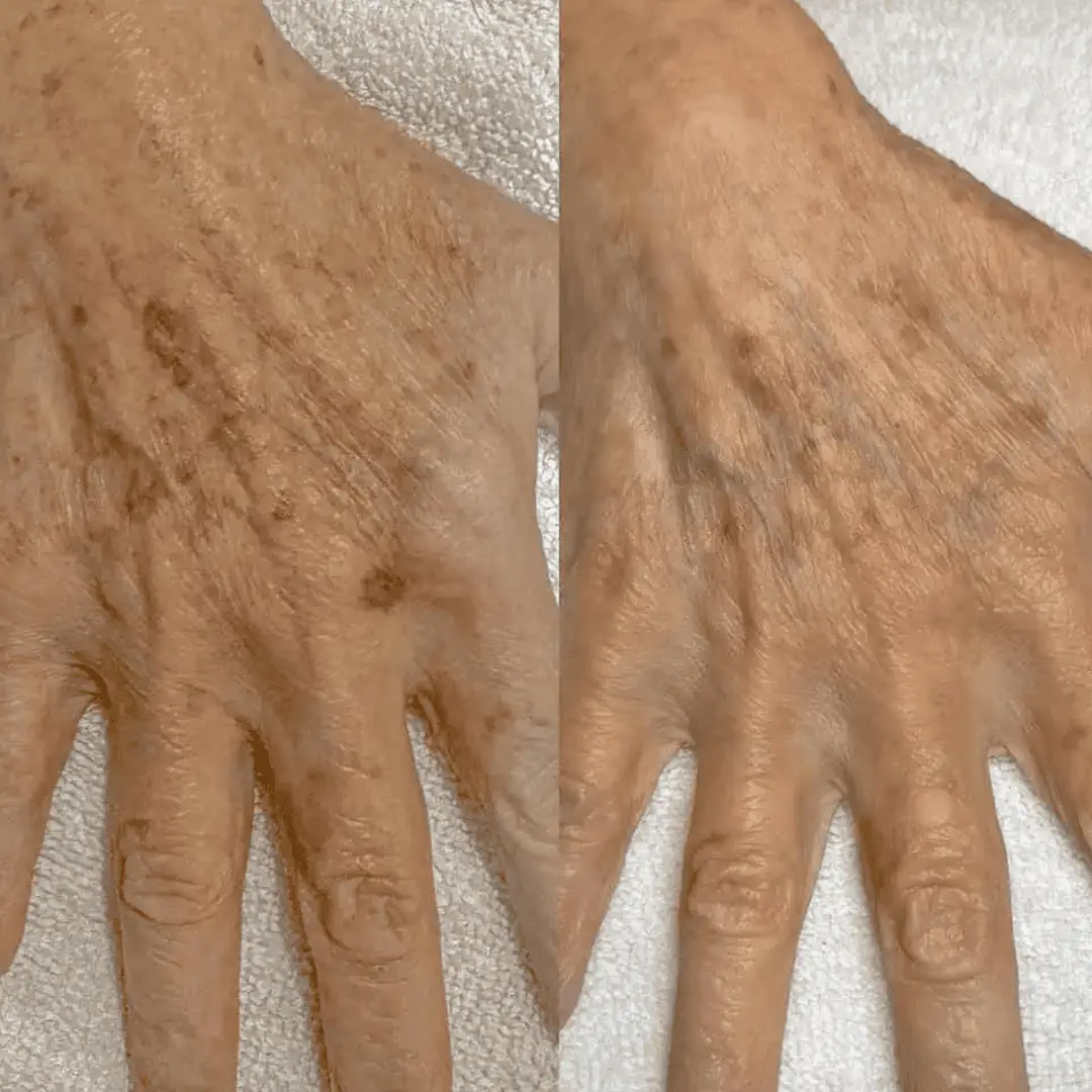 moxi-ipl-before-and-after