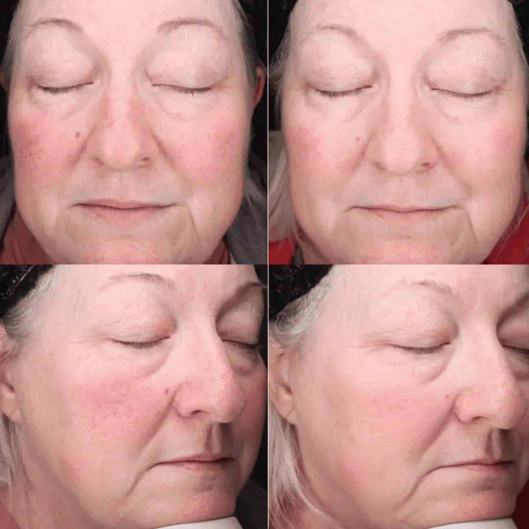 moxi-ipl-before-and-after