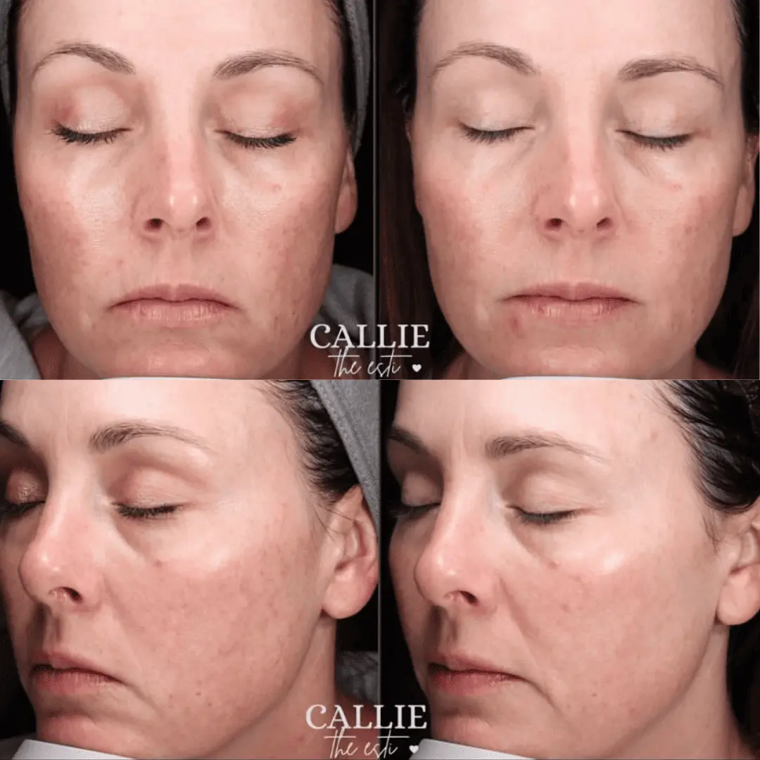 moxi-ipl-before-and-after