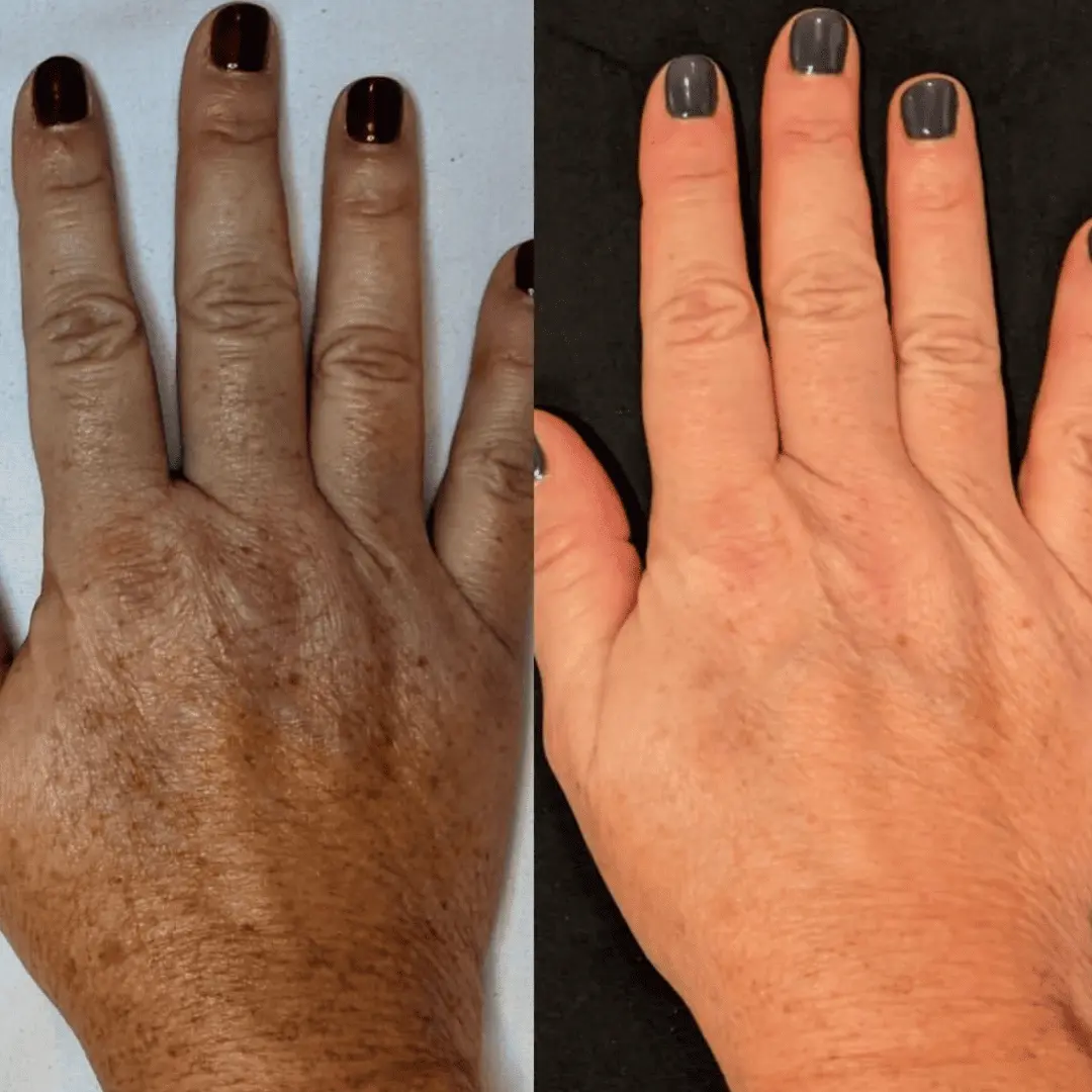 moxi-ipl-before-and-after