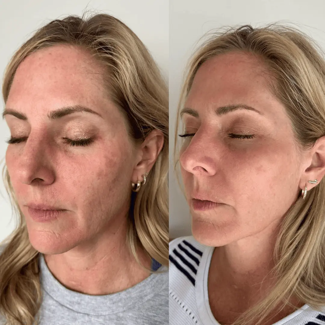 moxi-ipl-before-and-after