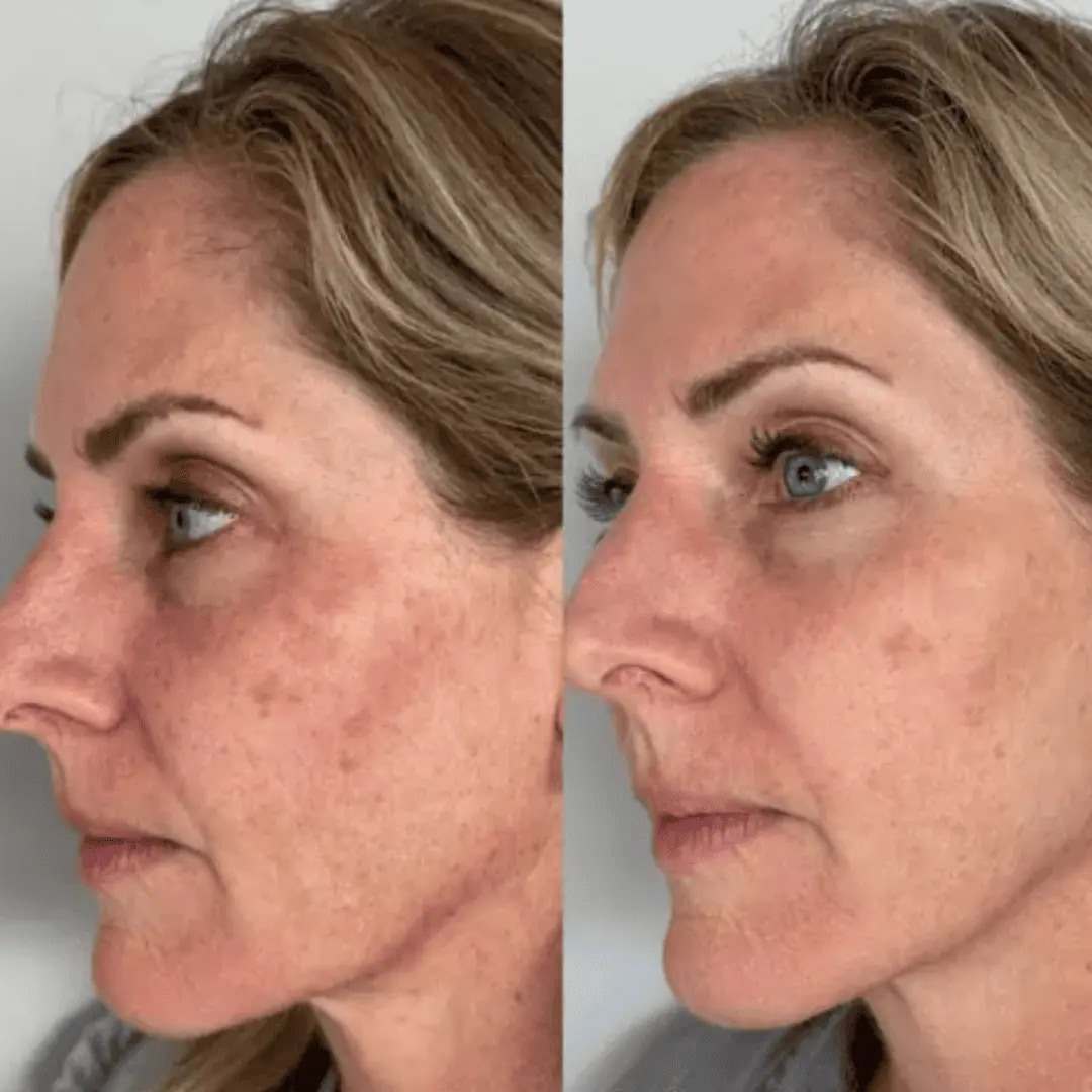 moxi-ipl-before-and-after