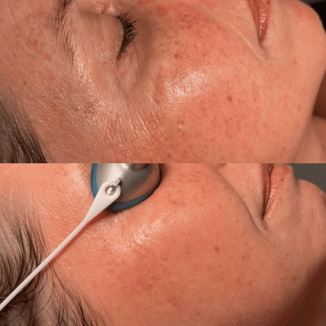 moxi-ipl-before-and-after