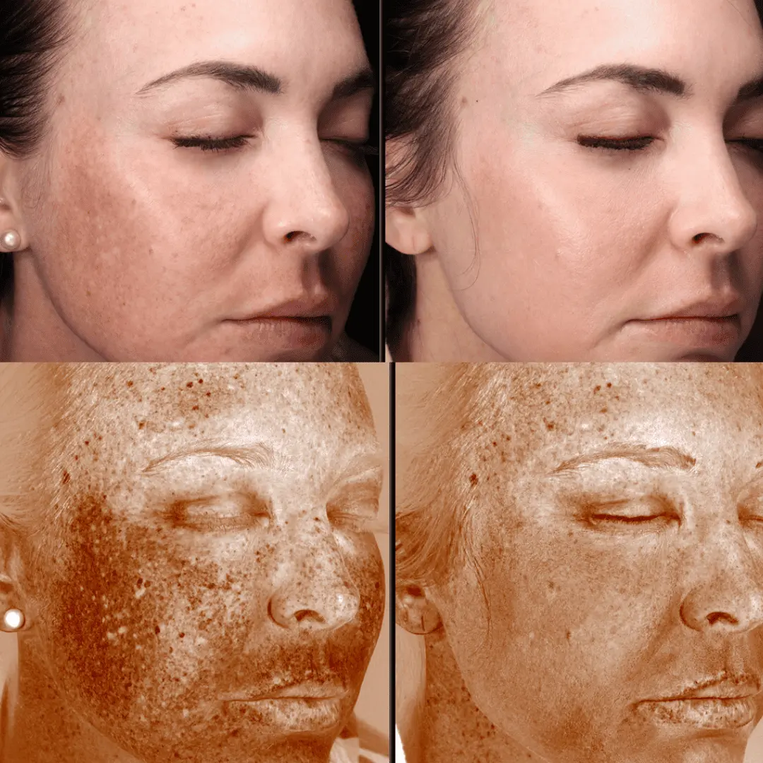 moxi-ipl-before-and-after