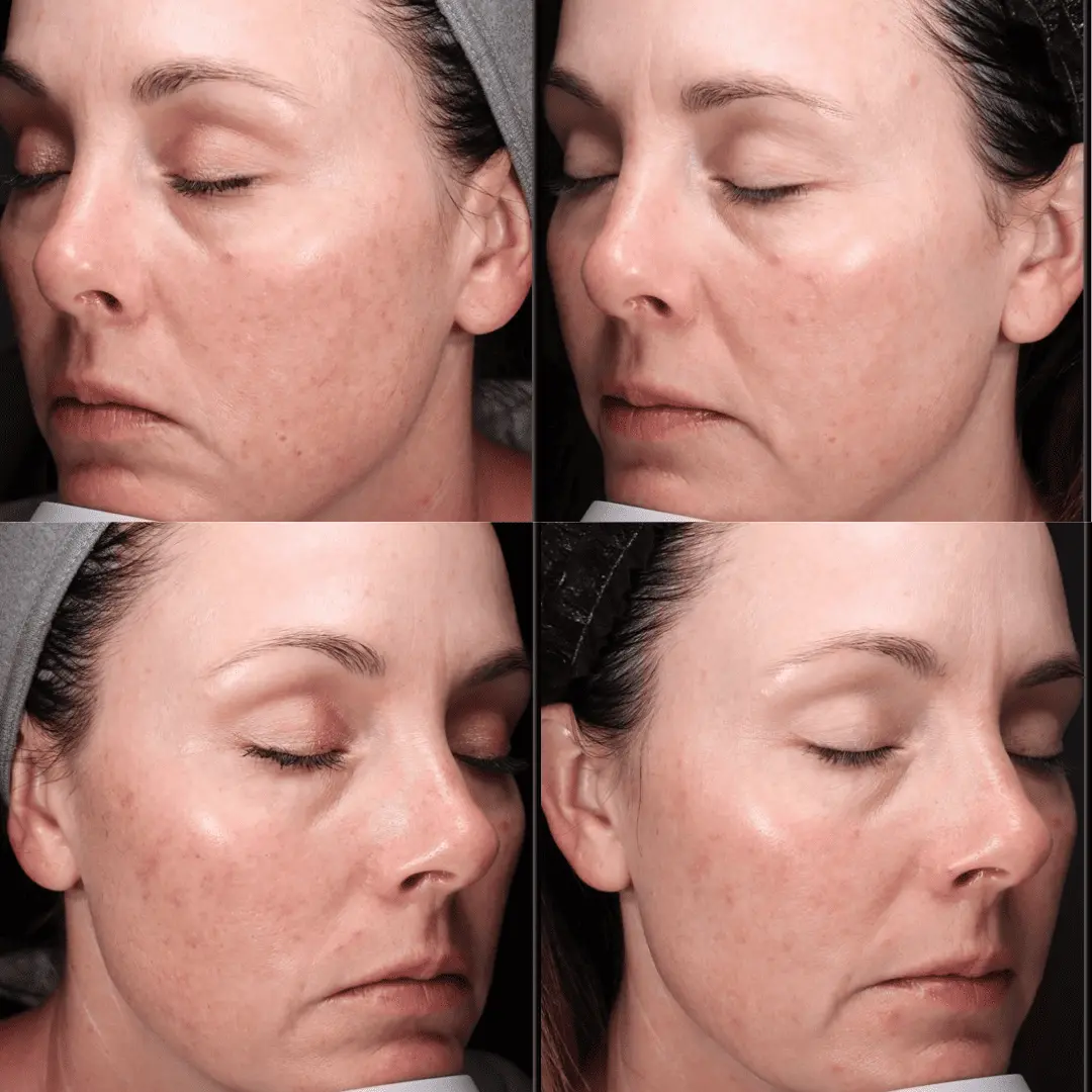 moxi-ipl-before-and-after