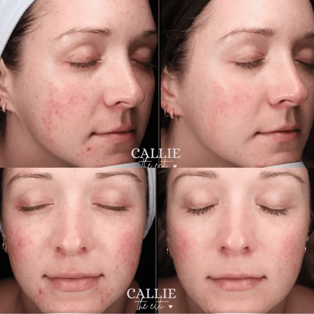 moxi-ipl-before-and-after