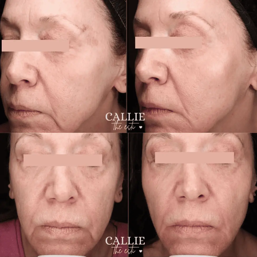 moxi-ipl-before-and-after