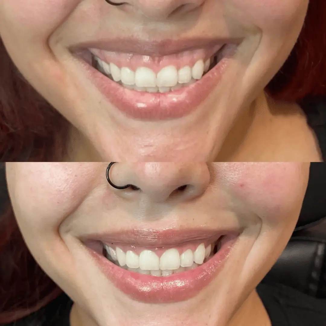 neurotoxin before and after by Refresh Medical Spa