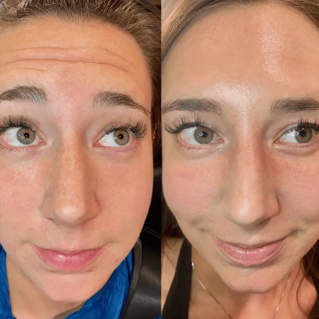 neurotoxin before and after by Refresh Medical Spa