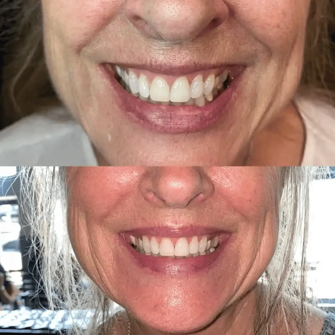 neurotoxin before and after